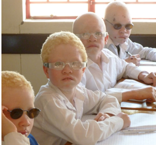 Special eyewear for albinism sufferers to be acquired and distributed nationwide