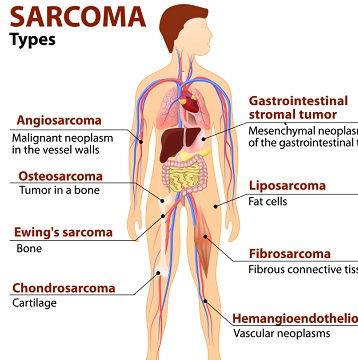 July observed as Sarcoma Cancer Awareness month