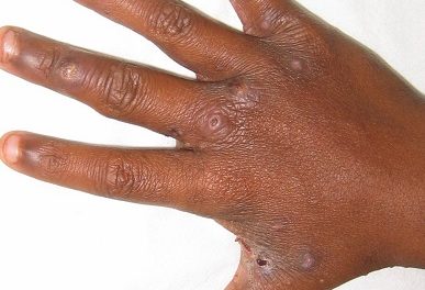 3454 cases of scabies countrywide from January to March
