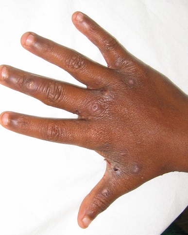 3454 cases of scabies countrywide from January to March