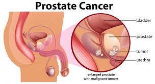 Cancer Association encourages men to go for their prostate examinations